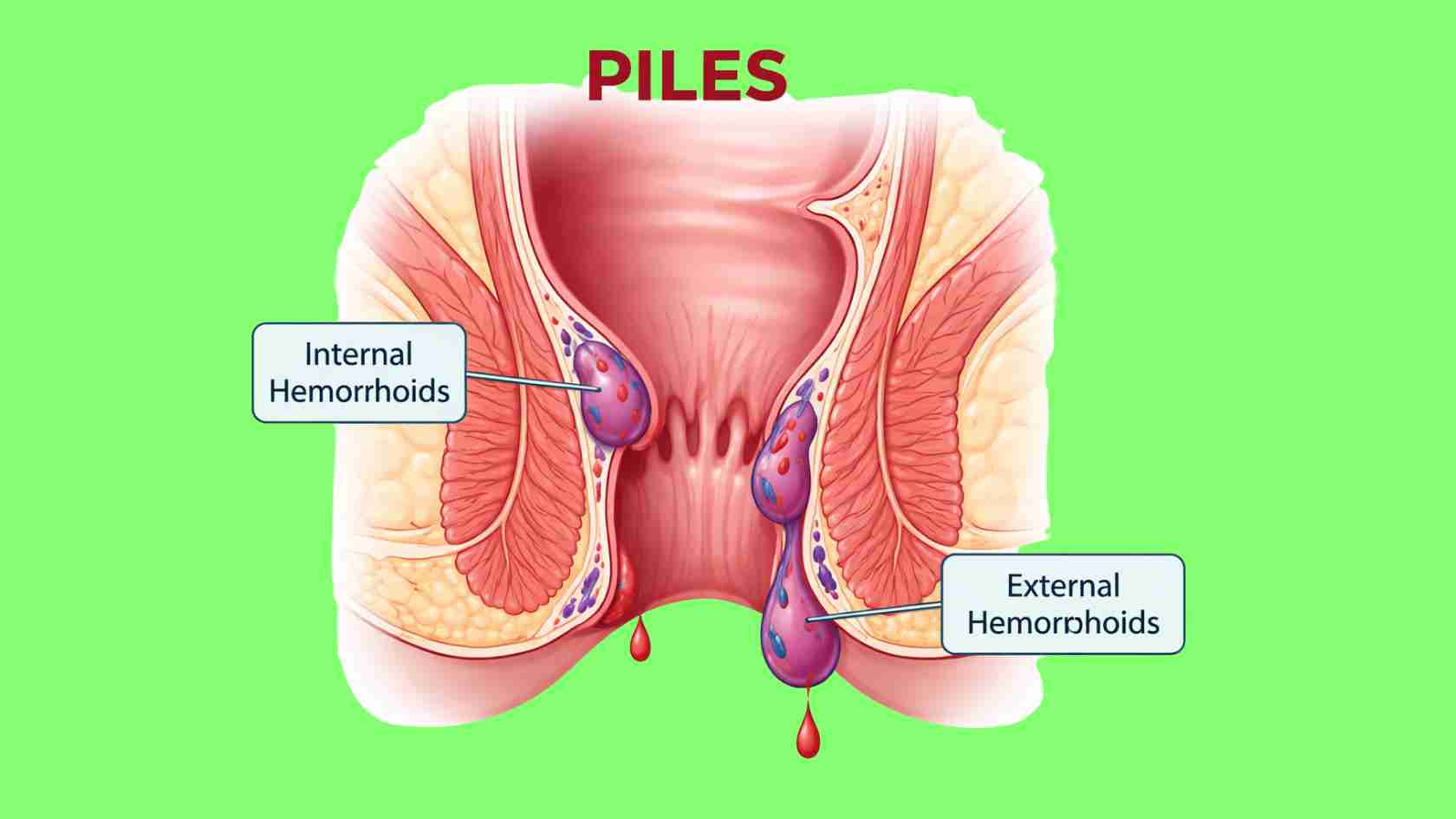 Best Herbals for Piles (Haemorrhoids)